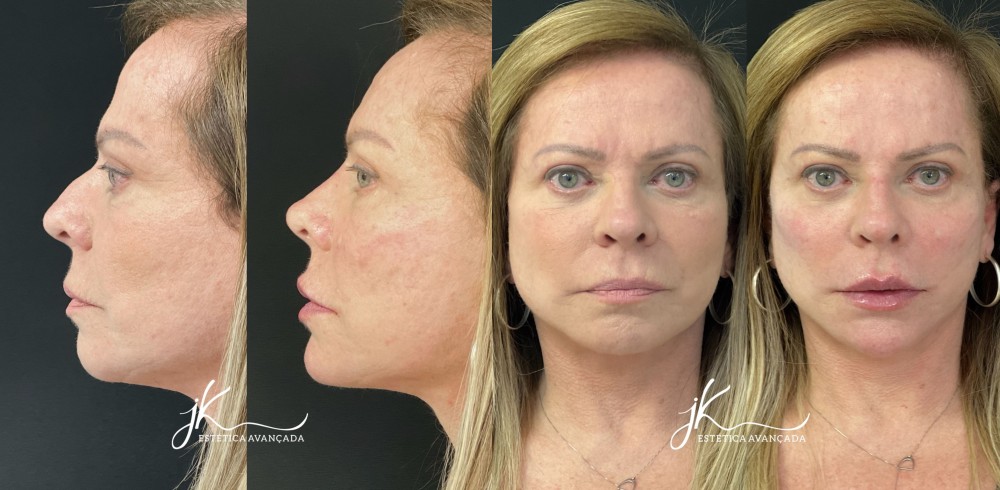 Ter as proporções faciais mais harmônicas pode ser o ponto-chave para conquistar uma autoestima mais elevada - Fotos: Ter as proporções faciais mais harmônicas pode ser o ponto-chave para conquistar uma autoestima mais elevada